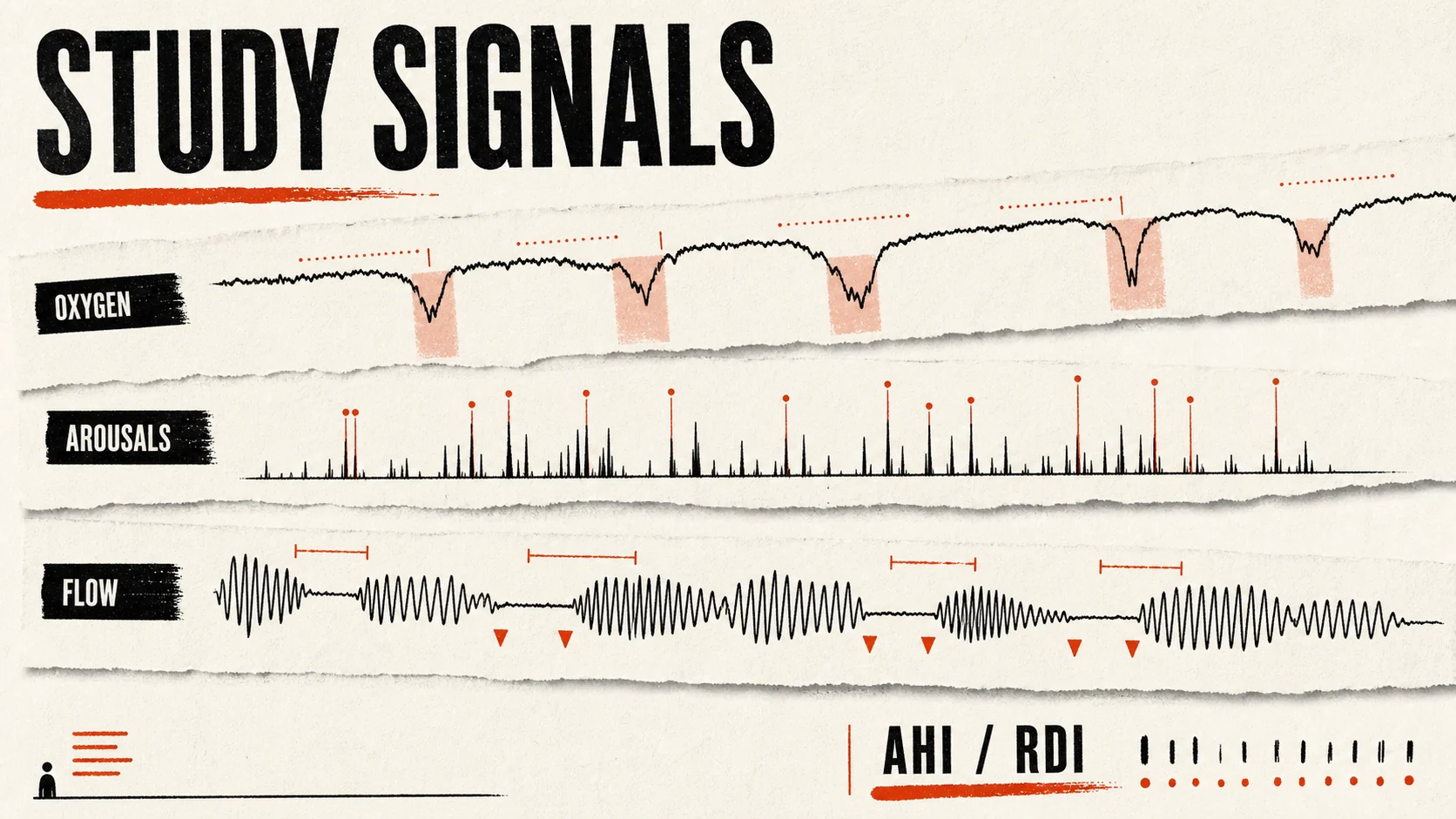 Editorial sleep-study signals showing oxygen, arousals, airflow, and AHI or RDI.